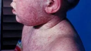 Measles confirmed in Christian County